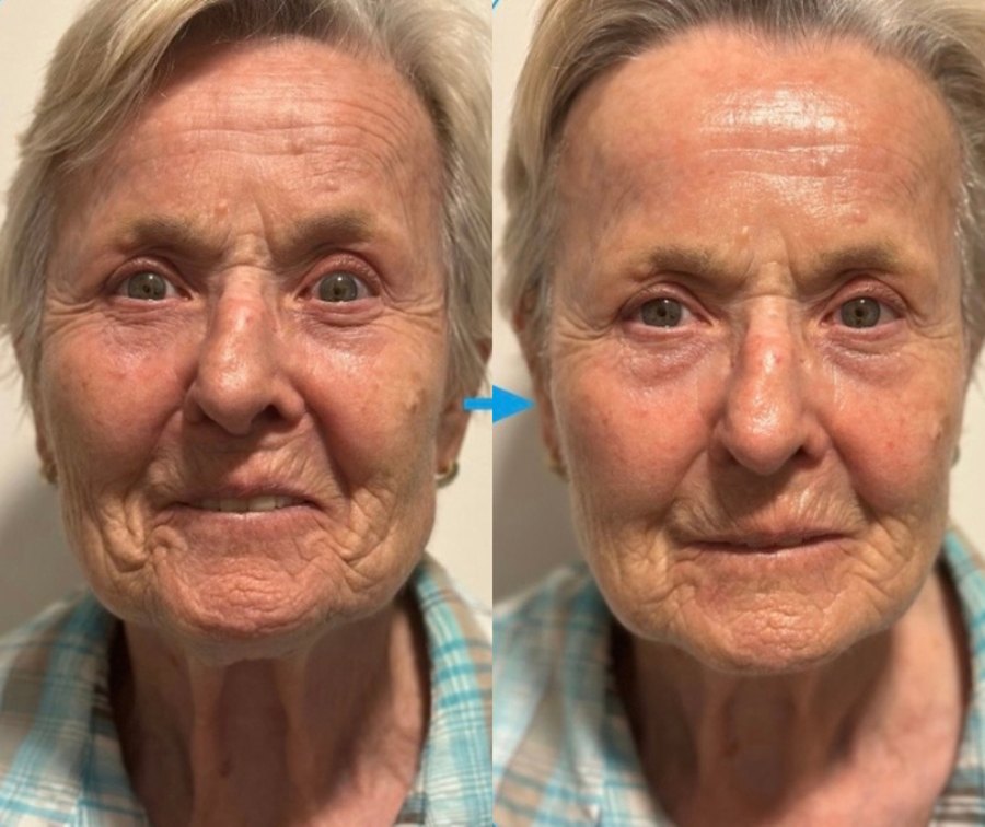 Vorher-Nachher-Ergebnis einer Wonder-Visage-Hautverjüngung