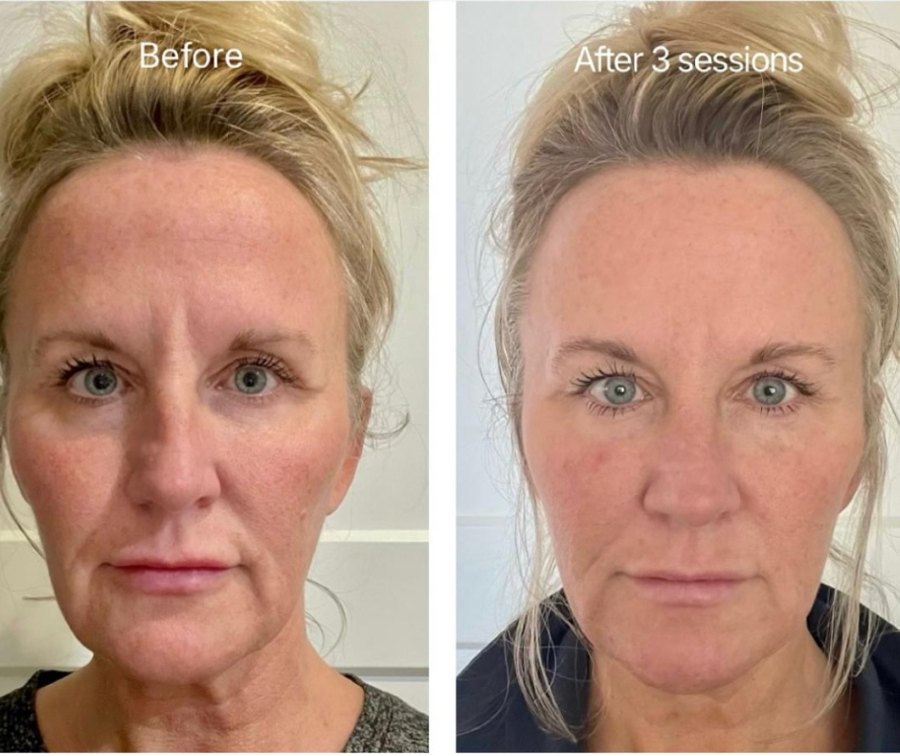 Vorher und nach drei Wonder-Visage-Behandlungen